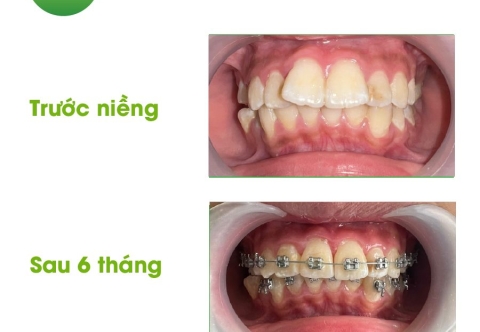 17 tuổi có nên niềng răng không? Niềng răng bao nhiêu tiền